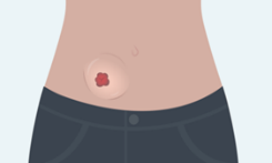 Stomazorg-parastomale hernia